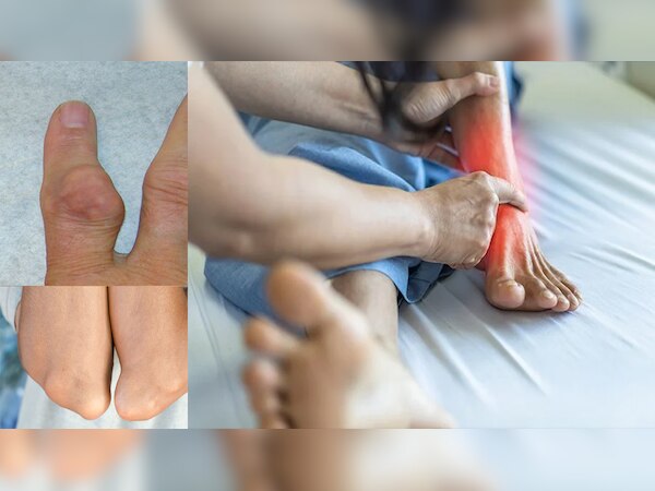 High Uric Acid: हाई यूरिक एसिड से हैं परेशान तो ये भूलकर भी ना करें काम