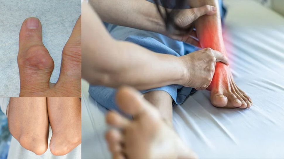 High Uric Acid: हाई यूरिक एसिड से हैं परेशान तो ये भूलकर भी ना करें काम High Uric Acid: हाई यूरिक एसिड से हैं परेशान तो ये भूलकर भी ना करें काम