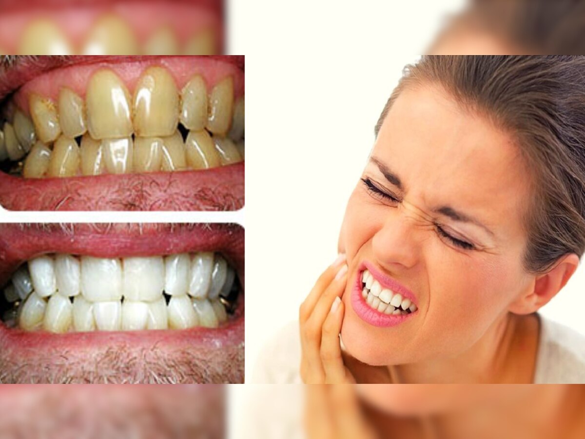 Teeth Whitening: दांतों का पीलापन दूर कराना खतरनाक, हो सकते ये Side Effects