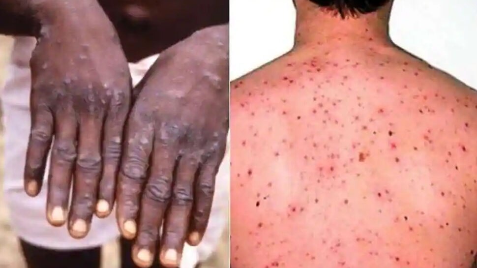 Monkeypox: क्या 'रिलेशन' बनाने से दुनिया में फैल रही 'मंकीपॉक्स' की बीमारी? हेल्थ एक्सपर्टों ने दी चेतावनी