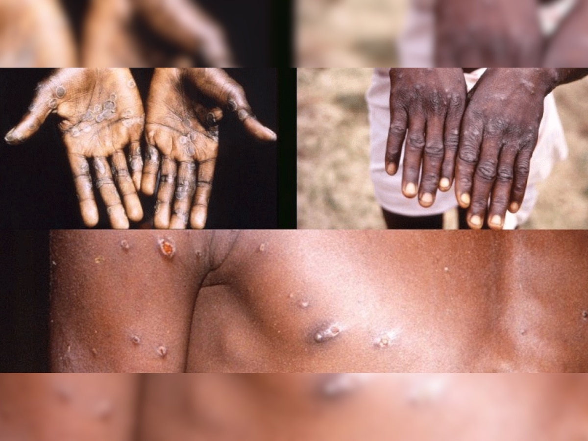 Monkeypox Virus Update: बच्चों, गर्भवती महिलाओं में मंकीपॉक्स वायरस गंभीर हो सकता है -WHO