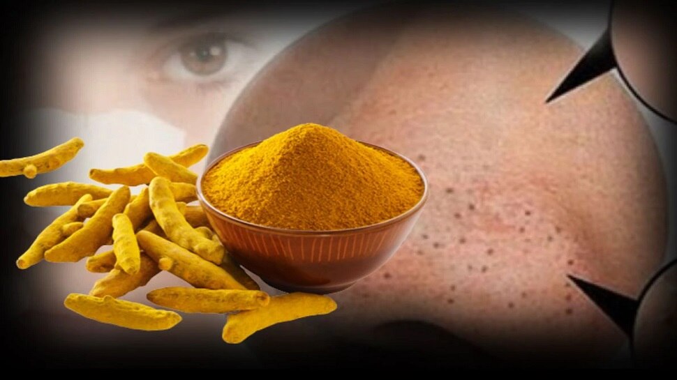 Blackheads Removal Tips Know Home Remedy For Blackheads And How To Blackheads removal tips know home remedy for blackheads and how to