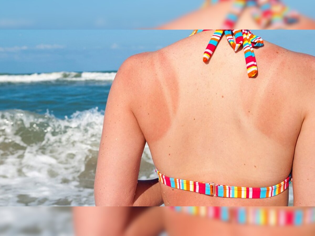 How To Remove Skin Tanning Sunburn Marks from Body Coconut Oil Ice