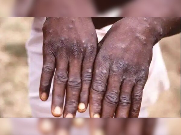 मंकीपॉक्स को लेकर अलर्ट पर यूपी सरकार, बताया- किन लोगों के लिए आइसोलेशन जरूरी