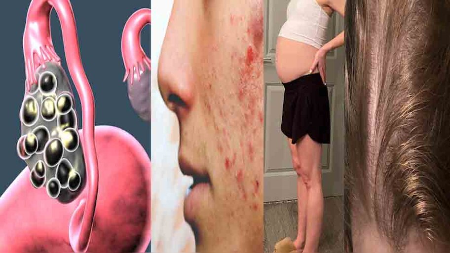 PCOD and PCOS: क्या होता है महिलाओं में होने वाला पीसीओडी? जानें लक्षण और इलाज