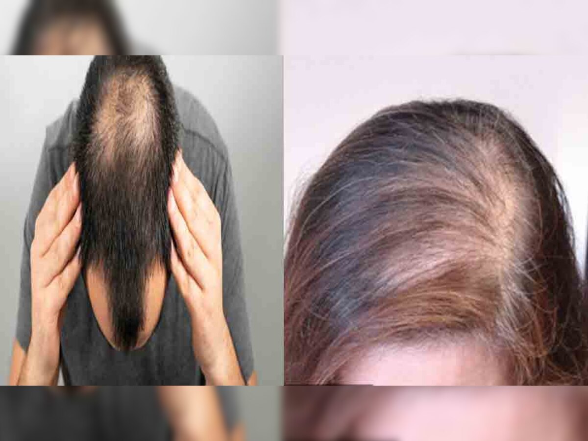 Hair loss treatment: जानें क्यों होता है हेयर लॉस और कैसे करें इसका घर पर इलाज