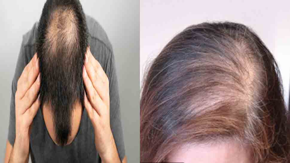 Hair loss treatment: जानें क्यों होता है हेयर लॉस और कैसे करें इसका घर पर इलाज Hair loss treatment: जानें क्यों होता है हेयर लॉस और कैसे करें इसका घर पर इलाज