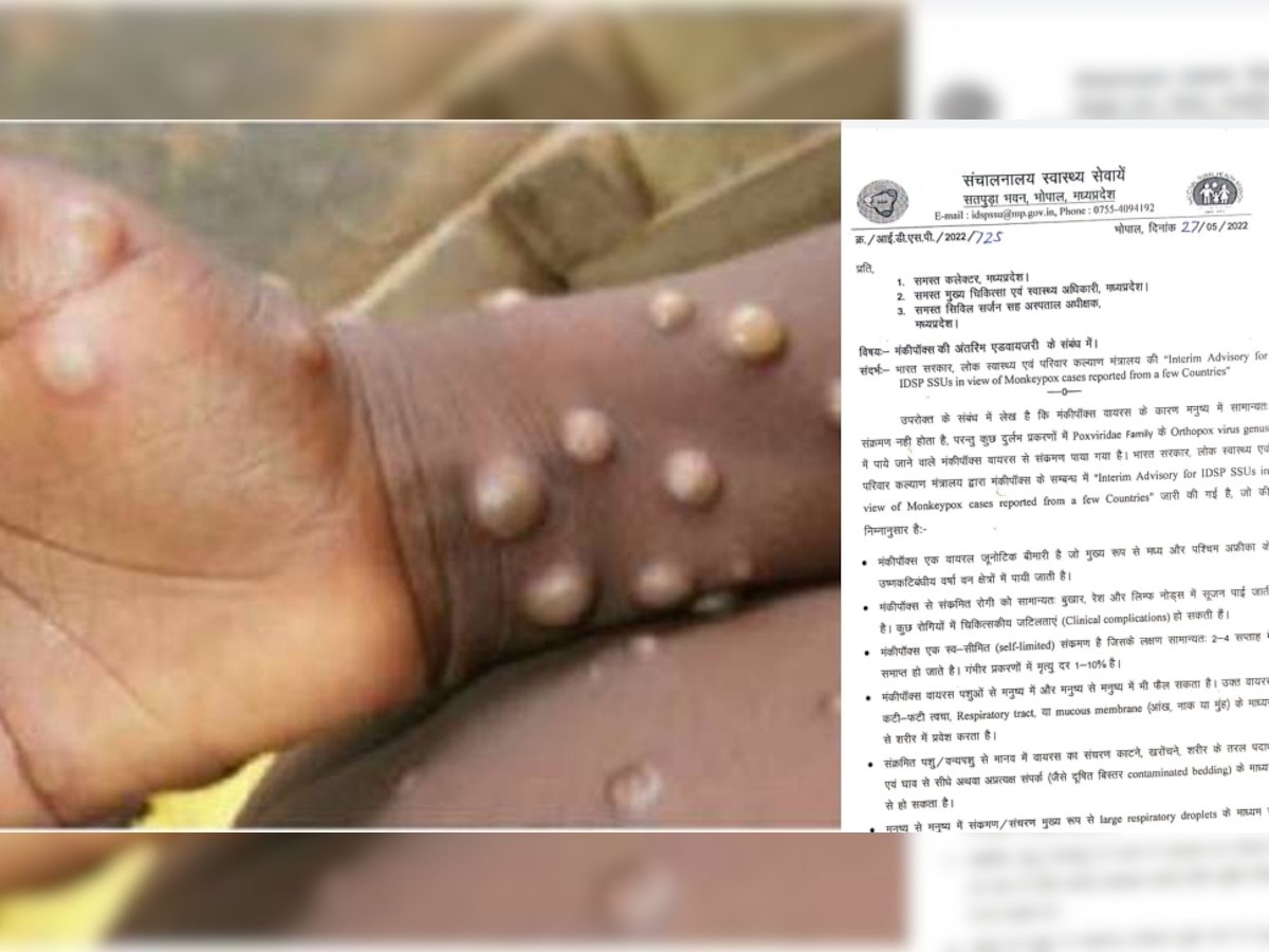 Monkeypox Alert: मंकीपॉक्स को लेकर मध्यप्रदेश में एडवाइजरी जारी, ऐसे होगा इलाज