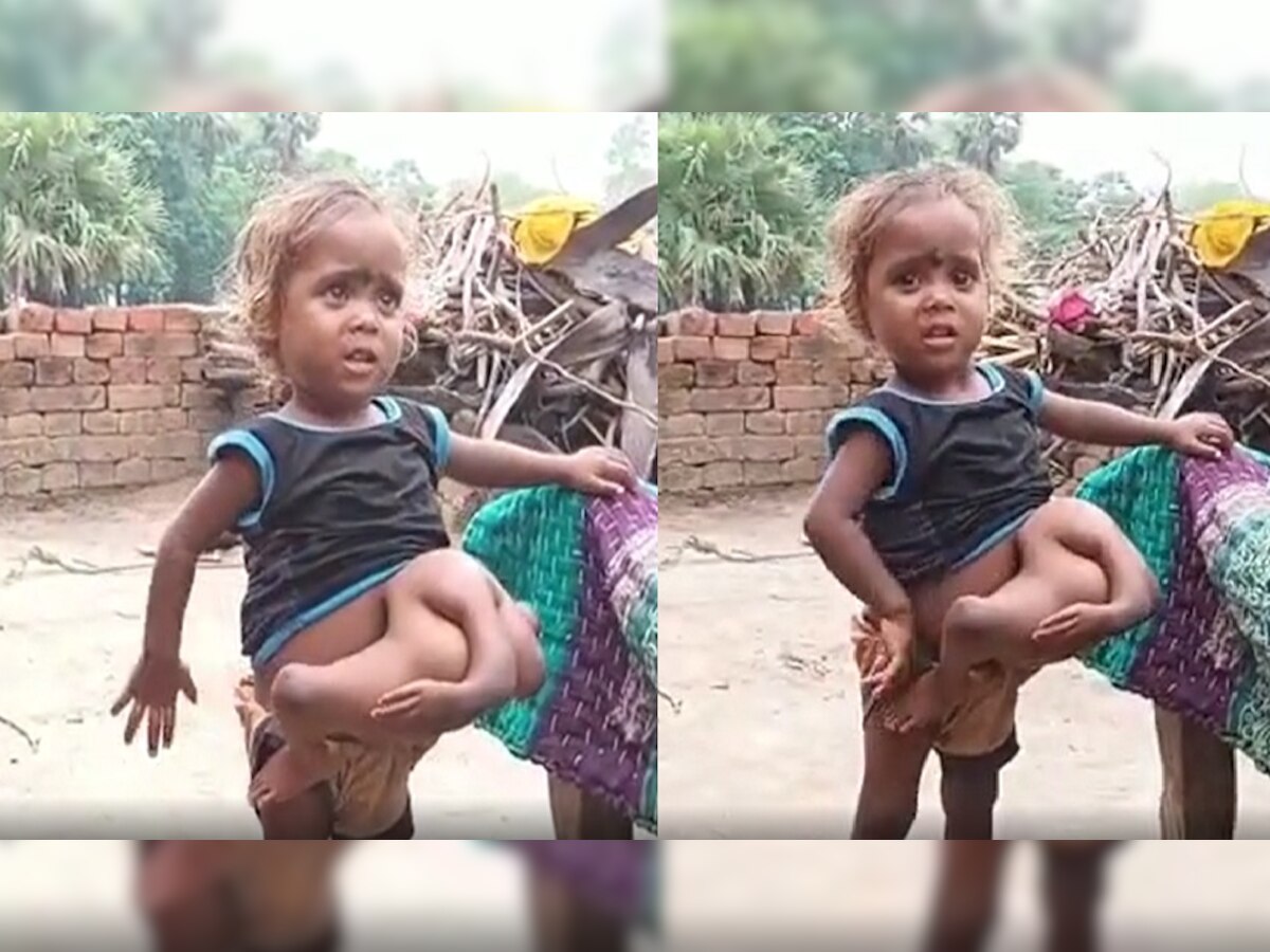 चार हाथ चार पैर वाली अनोखी बच्ची चहुमुखी कुमारी की सर्जरी के लिए आगे आए सोनू सूद, बुलाया मुंबई