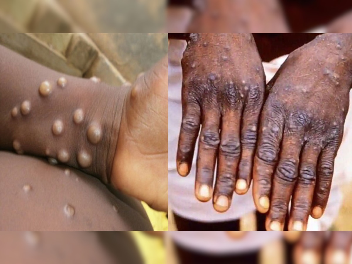 Monkey Pox Prevention Guidelines: दुनियाभर में पैर पसार रहा Monkey Pox, स्वास्थ्य मंत्रालय ने जताई चिंता; जारी की नई गाइडलाइन