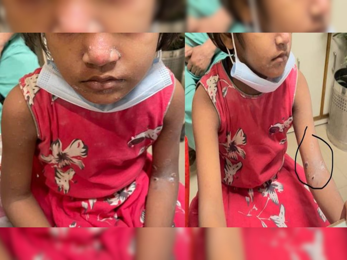 गाजियाबाद में 5 साल की बच्ची में दिखे Monkey Pox के लक्षण, जांच के लिए भेजा गया सैंपल 