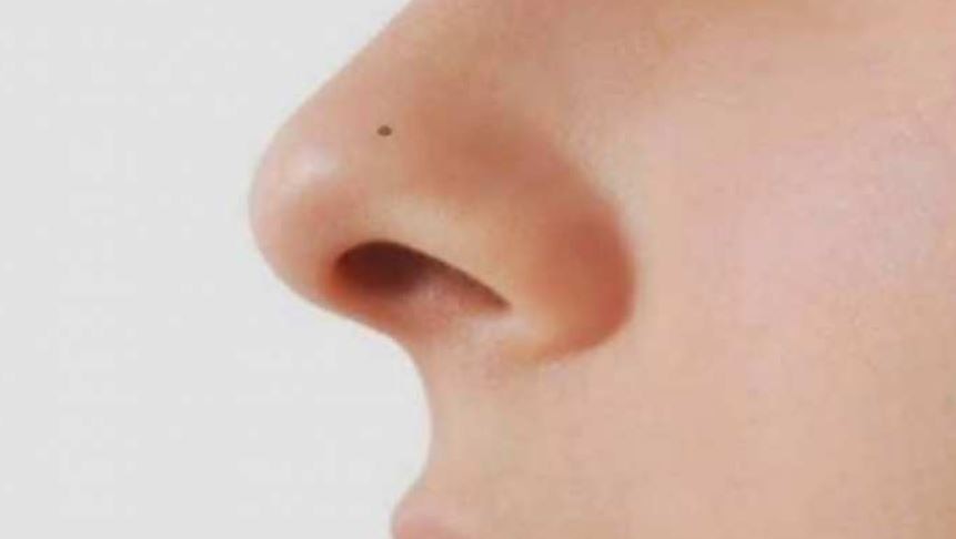 Mole on Nose: नाक पर तिल होने का मतलब क्या है? जानिए नाक पर तिल होना शुभ है या अशुभ