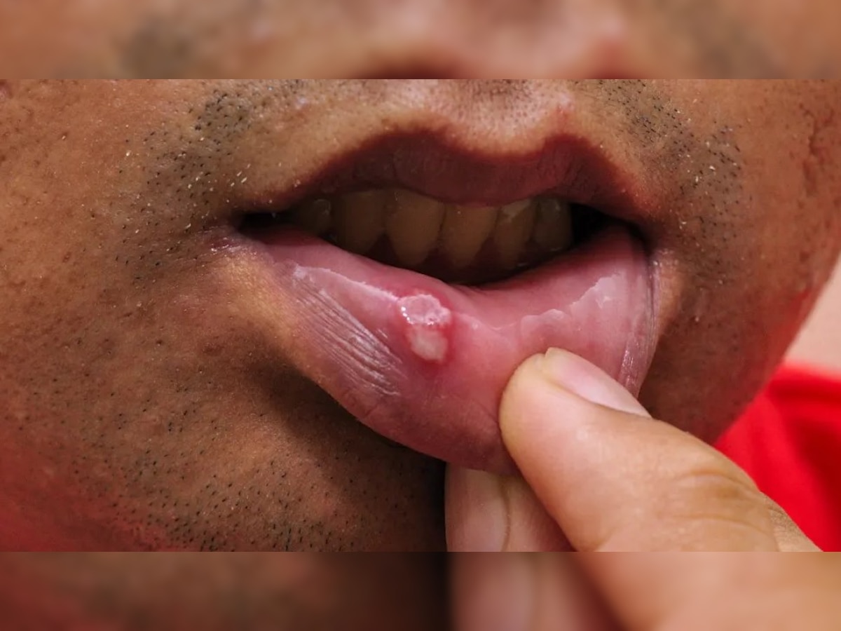 Treatment Of Mouth Ulcers