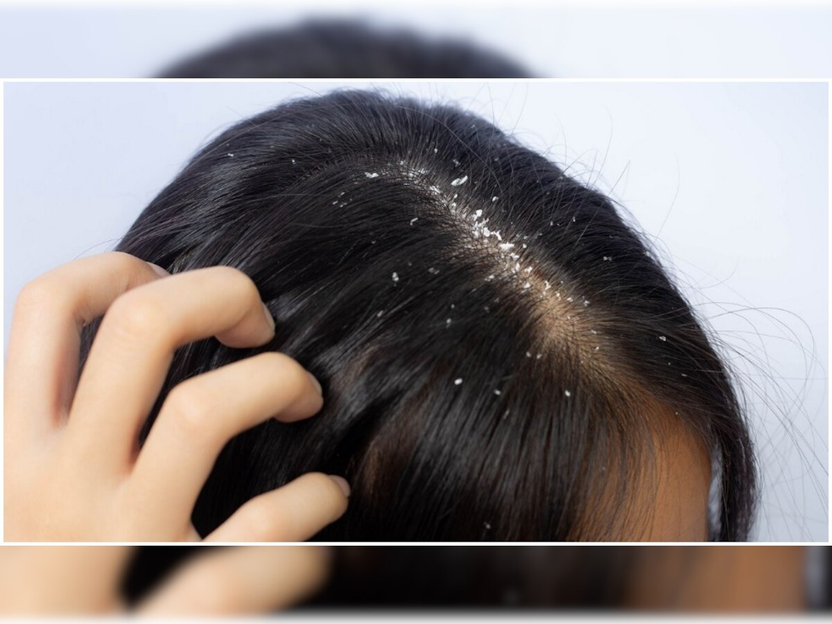 Hair Care Tips: गर्मियों के मौसम में बालों में डैंड्रफ से हैं परेशान? छुटकारा पाने के लिए अपनाएं ये उपाय