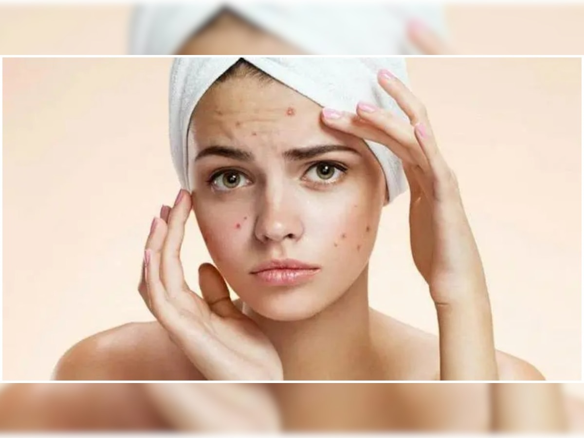 Skin Care Tips: गर्मियों में चेहरे पर मुहांसों से हैं परेशान? तो इस तरह करें देखभाल