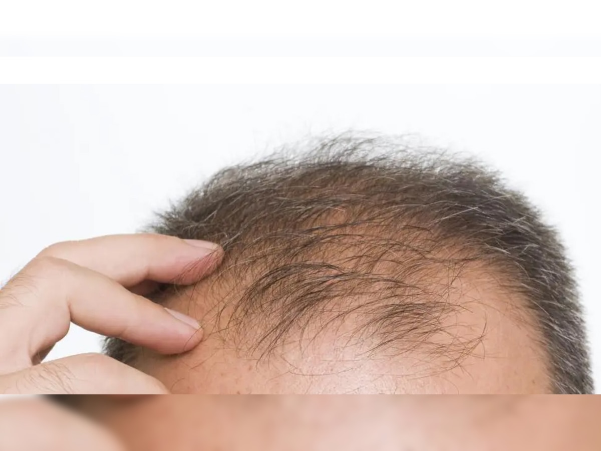 Hair fall Reason: कहीं इन चीजों की कमी के कारण तो नहीं गिर रहे हैं आपके बाल?