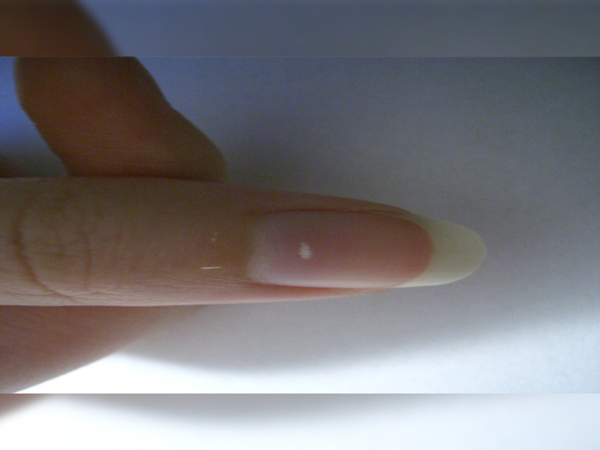 Nail white spot reason and how to remove it SMI Nail white spot अगर आपके नाखून पर दिखे ऐसे