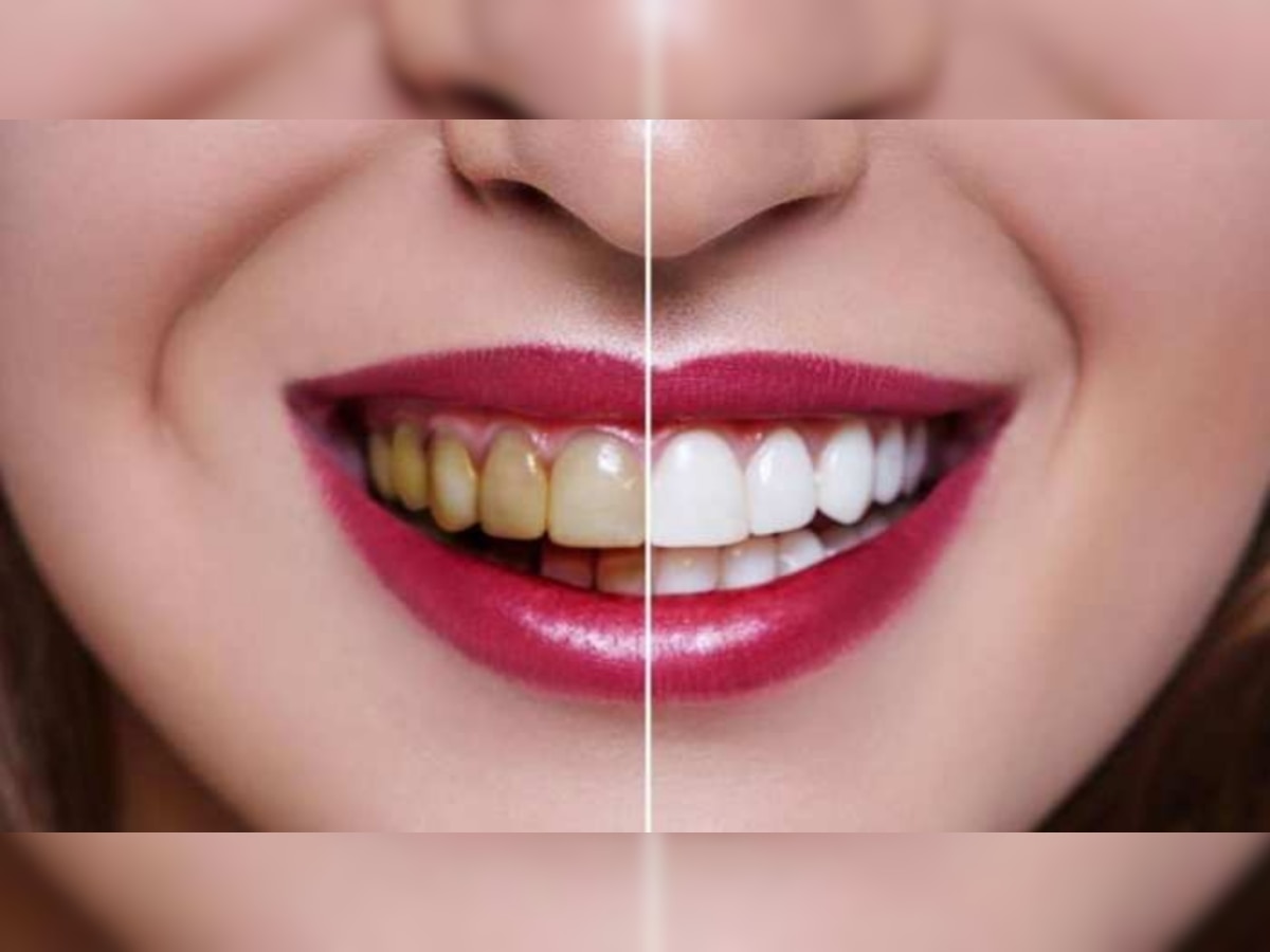 Teeth Whitening Tips : पीले दांतों को सफेद करने के 4 आसान उपाय, मिनटों में दिखेगा बदलाव