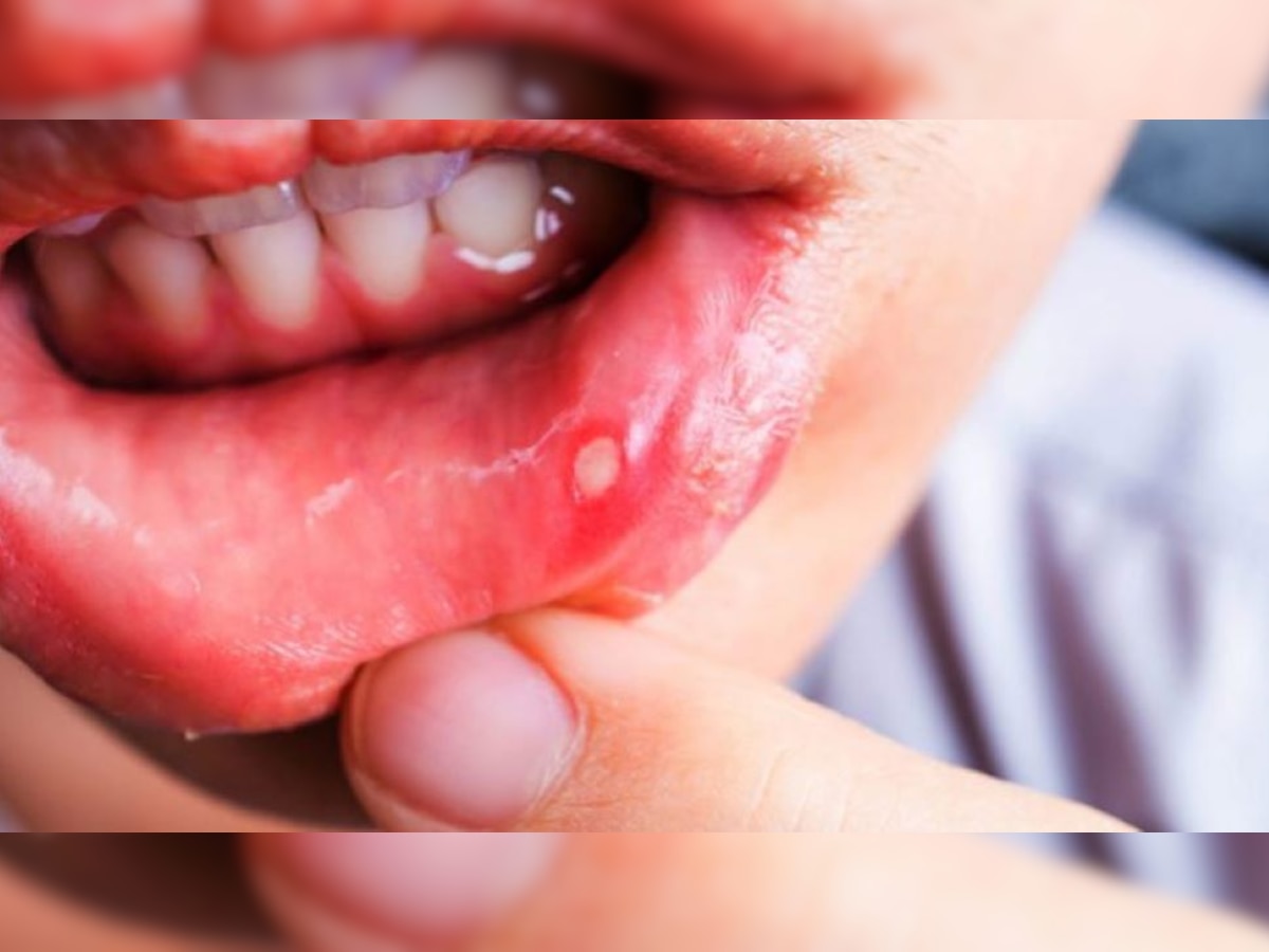 Mouth Ulcers: मुंह के छालों से हैं परेशान? तो इन तरीकों से मिलेगा आराम