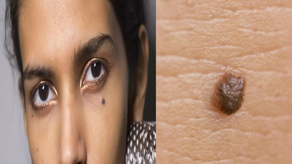 mole and massa removal skin for easy tips know how to remove wart