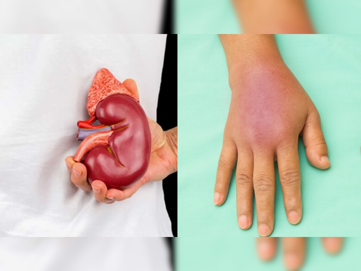 Swelling On Body Face Leg and Hand Reason is Thee Disease Heart Liver