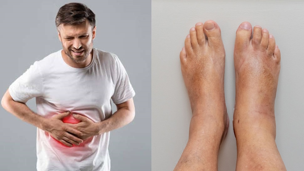 Swelling On Body Face Leg and Hand Reason is Thee Disease Heart Liver