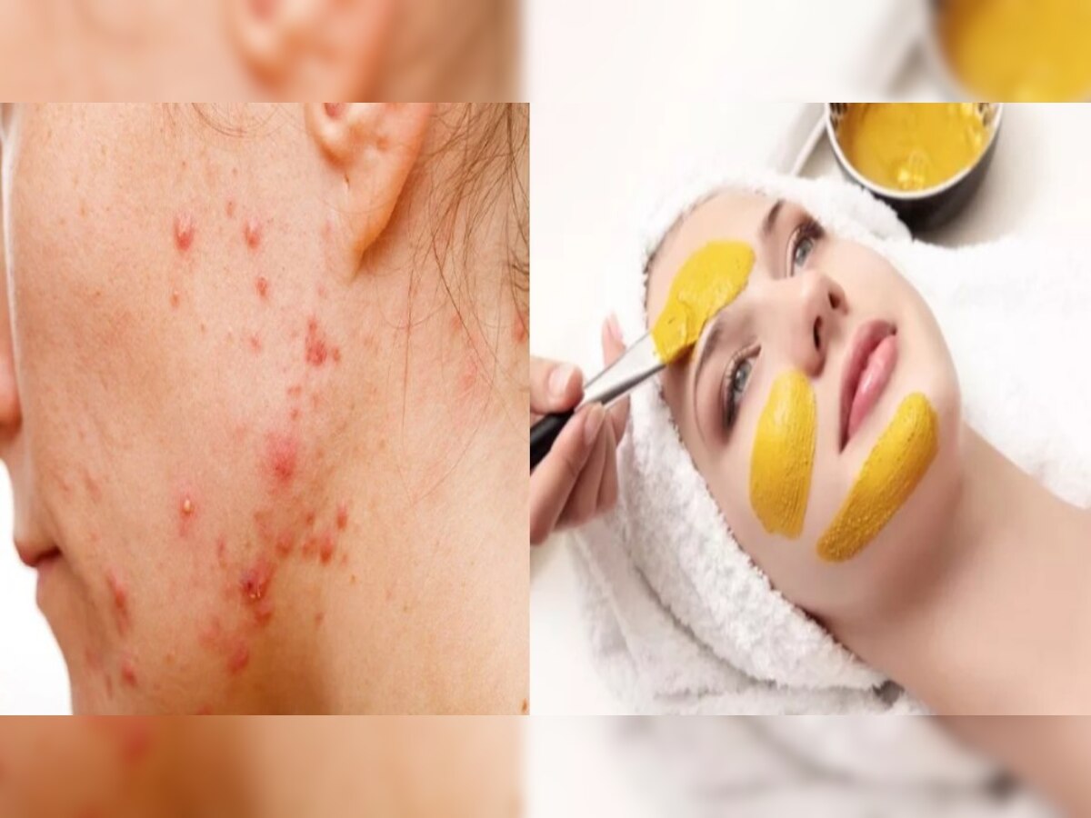 Remove Pimple: बरसात में पिंपल्स को स्कीन से करें दूर, बस घर बैठे करें ये काम