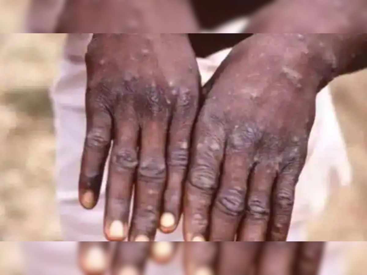 Monkeypox Case: मंकीपॉक्स ने बढ़ाई टेंशन, केंद्र सरकार ने जारी किए दिशा-निर्देश जारी