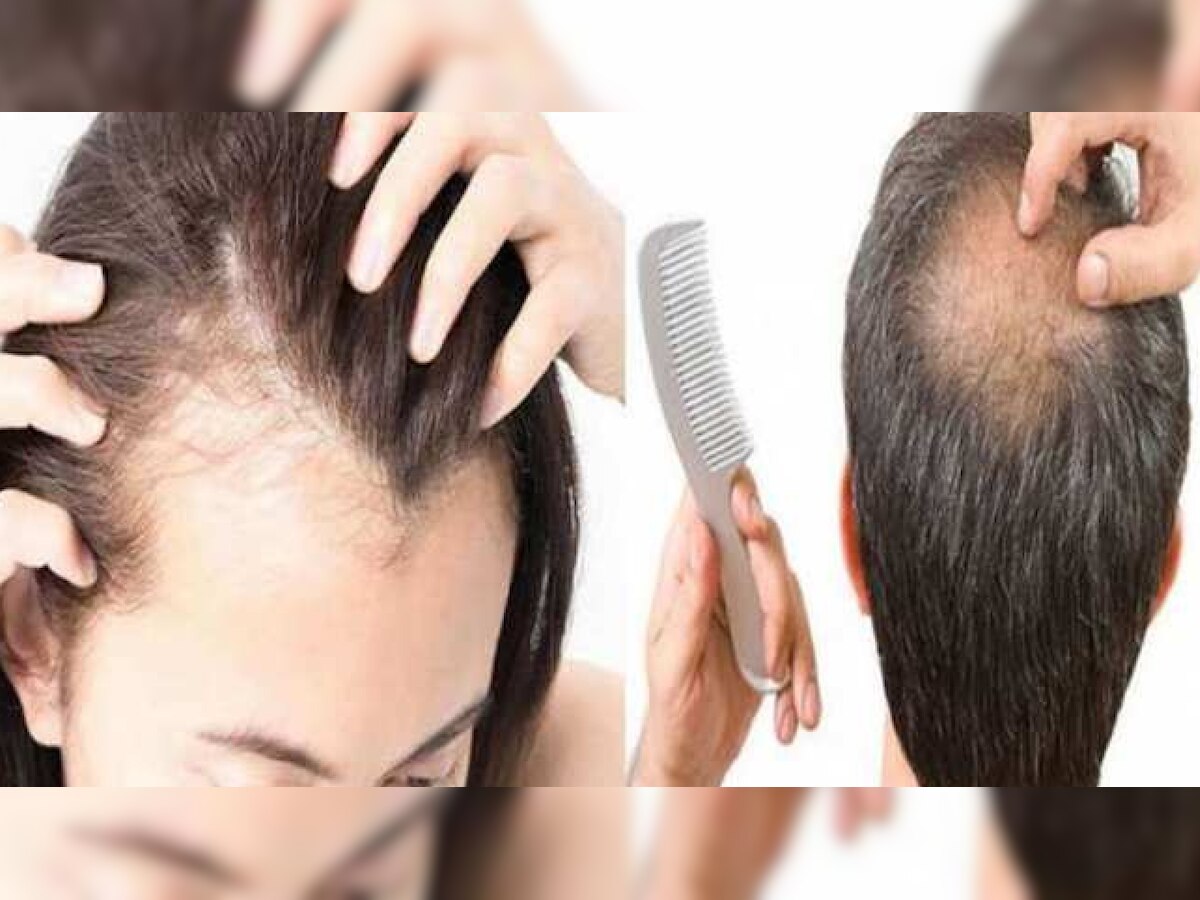 Hair Loss Home Remedies