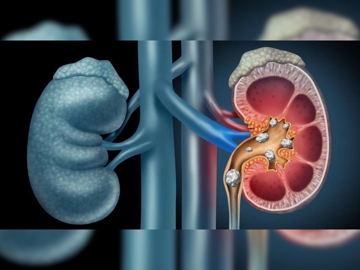 Kidney Stone ପାଇଁ ଦାୟୀ ଭୁଲ ଖାଦ୍ୟ ଅଭ୍ୟାସ, ଜାଣନ୍ତୁ କେଉଁ ଖାଦ୍ୟ ବନୁଛି ରୋଗର କାରଣ 