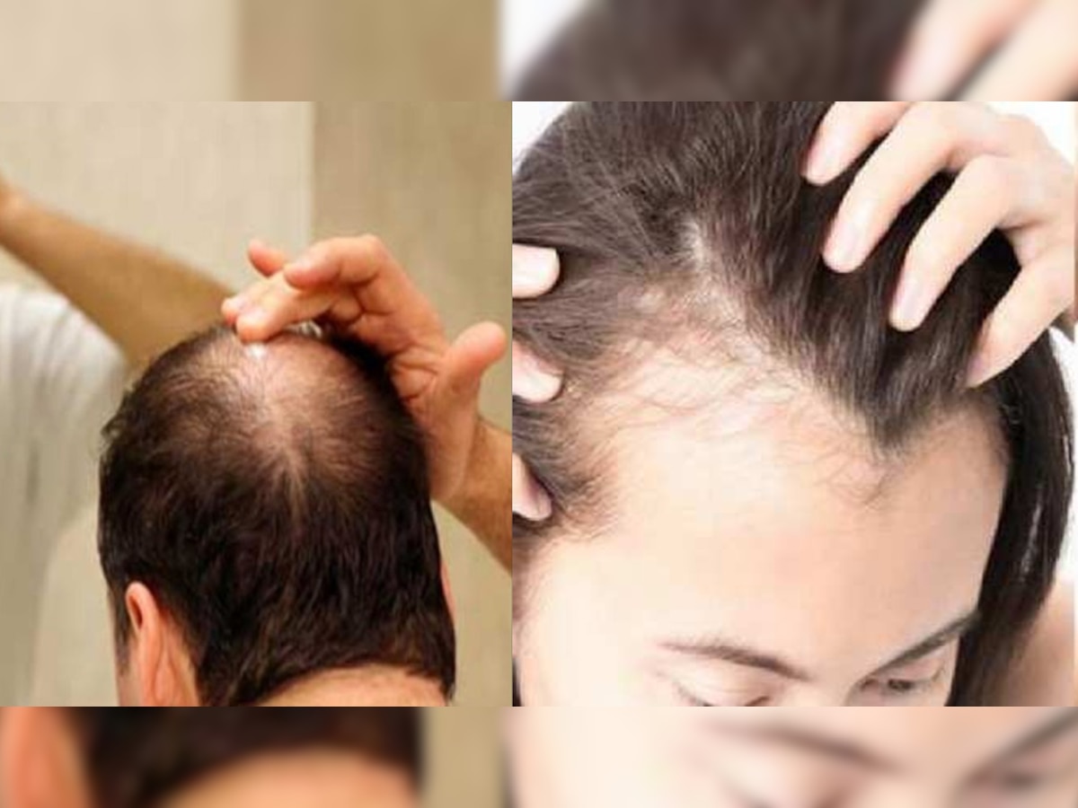 Hairfall Reason: कहीं इन इन कारणों से तो नहीं झड़ रहे आपके बाल? यह घरेलू उपाय हैं रामबाण