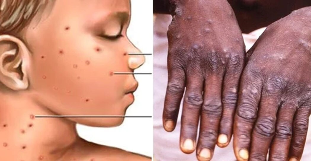 Monkeypox : 8 साल से छोटे बच्चों में संक्रमण का खतरा ज्यादा, ग्लोबल हेल्थ इमरजेंसी घोषित हुआ मंकीपॉक्स