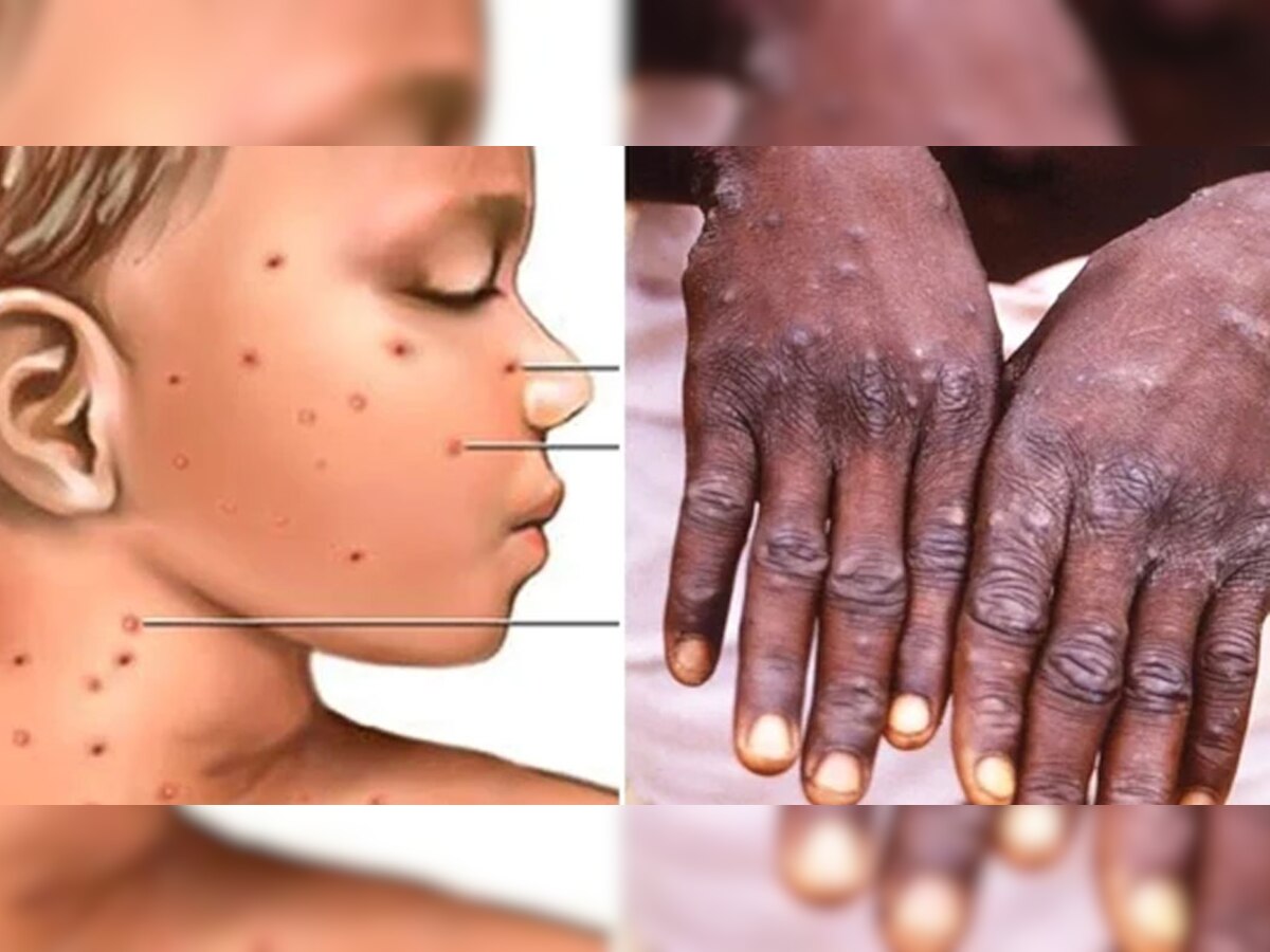 Monkeypox  : 8 साल से छोटे बच्चों में संक्रमण का खतरा ज्यादा, ग्लोबल हेल्थ इमरजेंसी घोषित हुआ मंकीपॉक्स
