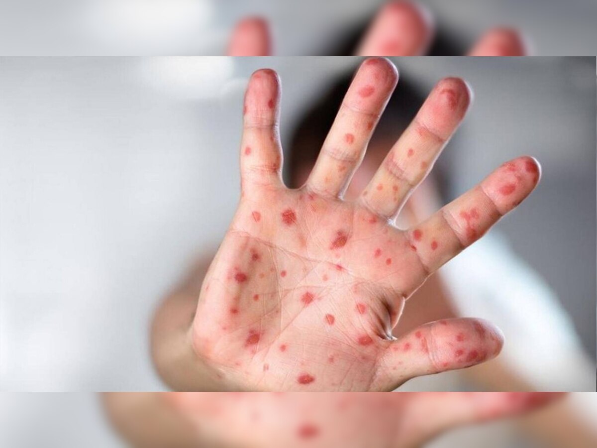 Monkeypox से सावधान! बचने के लिए तुरंत डाउनलोड करें ये App; जानिए कैसे फैलता है और कैसे बचाएगा