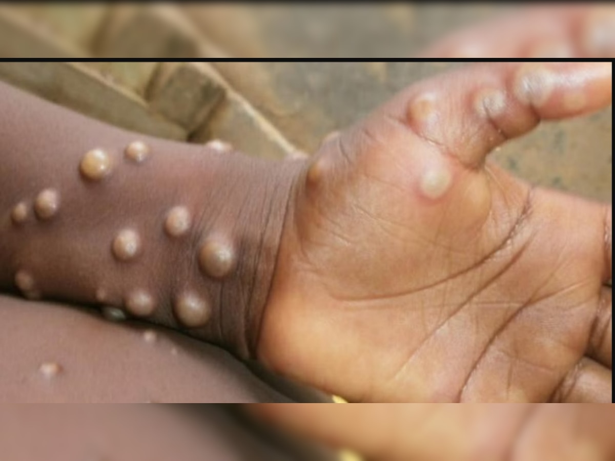 Monkeypox के बढ़ते मामलों ने बढ़ाई टेंशन, जानें क्या हैं लक्षण और कैसे करें बचाव 