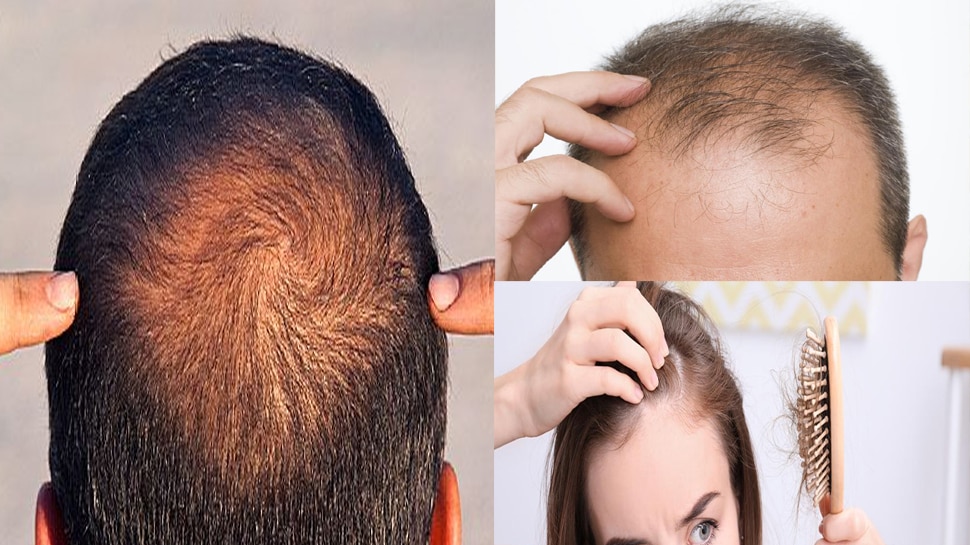 Bal jhadna kese roke or How to stop hair fall homemade remedy and treatment  for hairloss | Baal jhadna roke: बाल झड़ने का जड़ से करना हैं को इलाज, तो  अपनाए यह