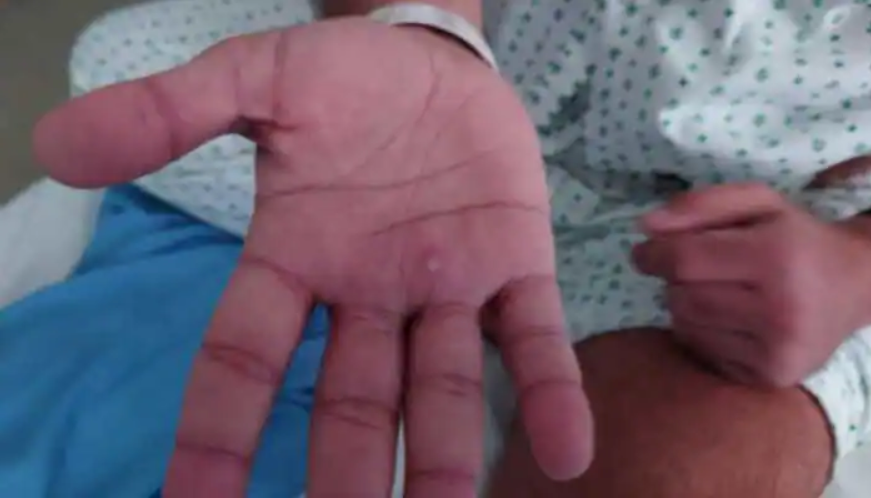 Monkeypox in Delhi: दिल्ली में मिला मंकीपॉक्स का दूसरा संदिग्ध केस, मरीज LNJP अस्पताल में भर्ती Monkeypox in Delhi: दिल्ली में मिला मंकीपॉक्स का दूसरा संदिग्ध केस, मरीज LNJP अस्पताल में भर्ती