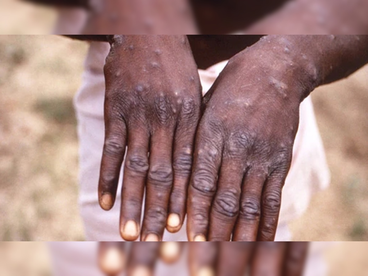 Monkeypox symptoms: मंकीपॉक्स के यह लक्षण दिखते ही खुद को कर लें आइसोलेट और करें ये काम