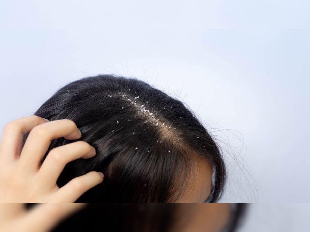 Hair Care Tips: आपके भी बाल और स्कैल्प रहते हैं ऑयली? तो जानें क्या है वजह