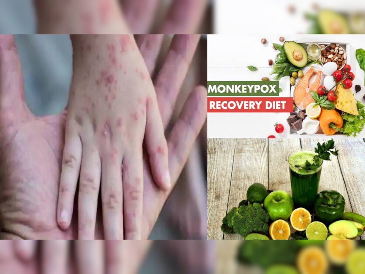Monkeypox Diet Plan: मंकीपॉक्स से संक्रमित होने पर ऐसी होनी चाहिए डाइट, जल्द होगी रिकवरी