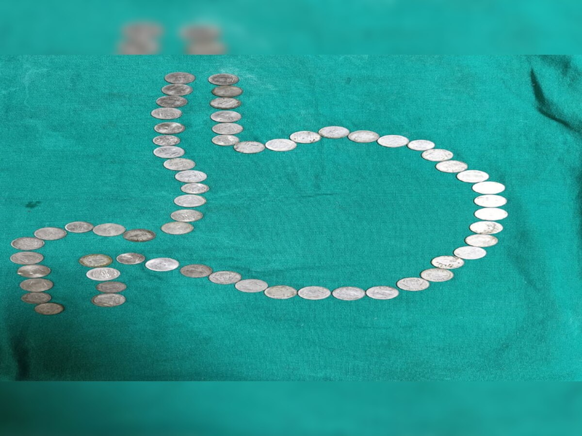 जोधपुर में एक युवक के पेट में मिले 50 से अधिक सिक्के, दो दिन तक चली एंडोस्कोपी