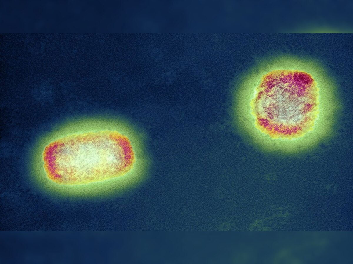 Monkeypox और Chickenpox को लेकर कंफ्यूज हैं आप? डॉक्टरों ने बताया कैसे अलग हैं दोनों बीमारी