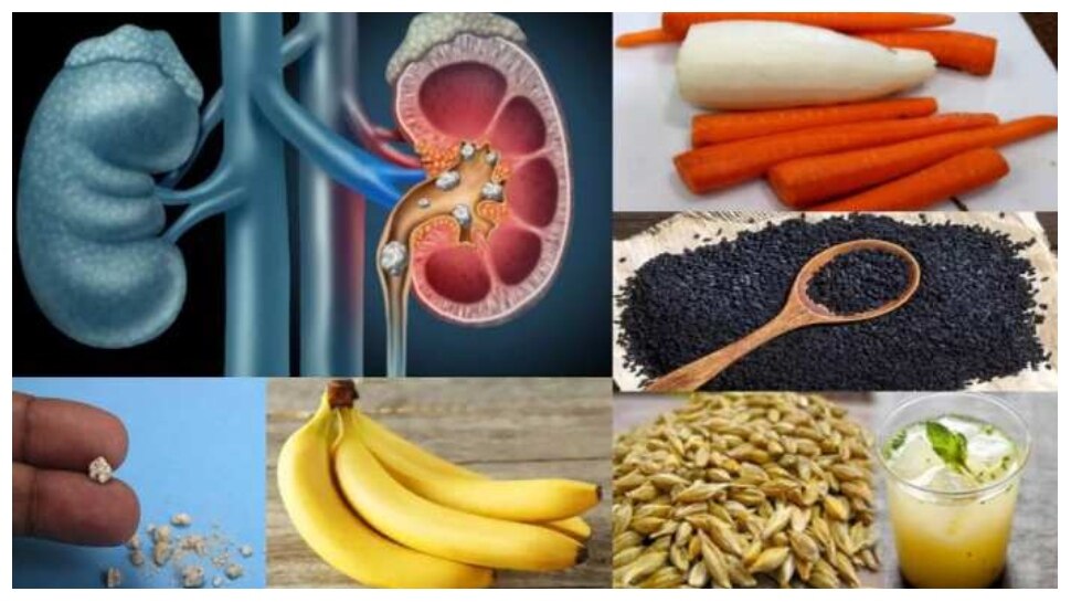 Kidney Stone Diet, Know What to Eat and What Not To Eat In Kidney problem | Kideny Stone: डेली डाइट से हो सकती है पथरी, किडनी स्टोन होने पर क्या खाएं, और