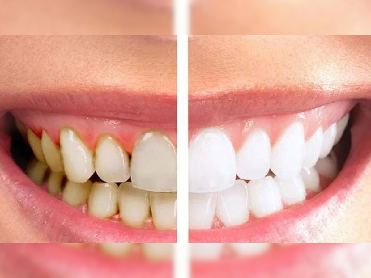 White Teeth Tips: दातों के पीलेपन से हैं परेशान, तो इन घरेलू टिप्स को करें फॉलो; मोतियों जैसे चमकने लगेंगे!