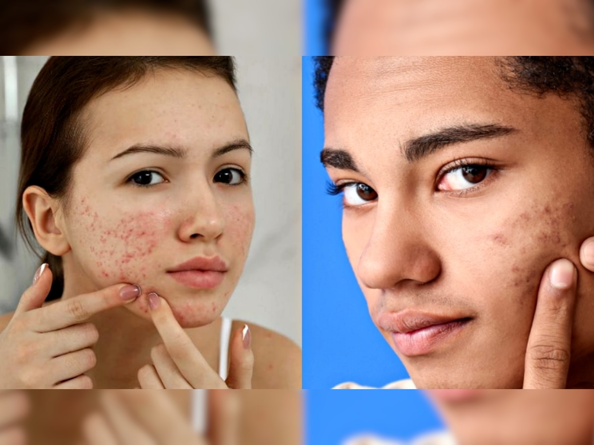 Pimples on Face : चेहरे पर दाग धब्बों के पीछे हैं ये 4 विटामिन, कमी दूर करने के लिए जानें सही डाइट