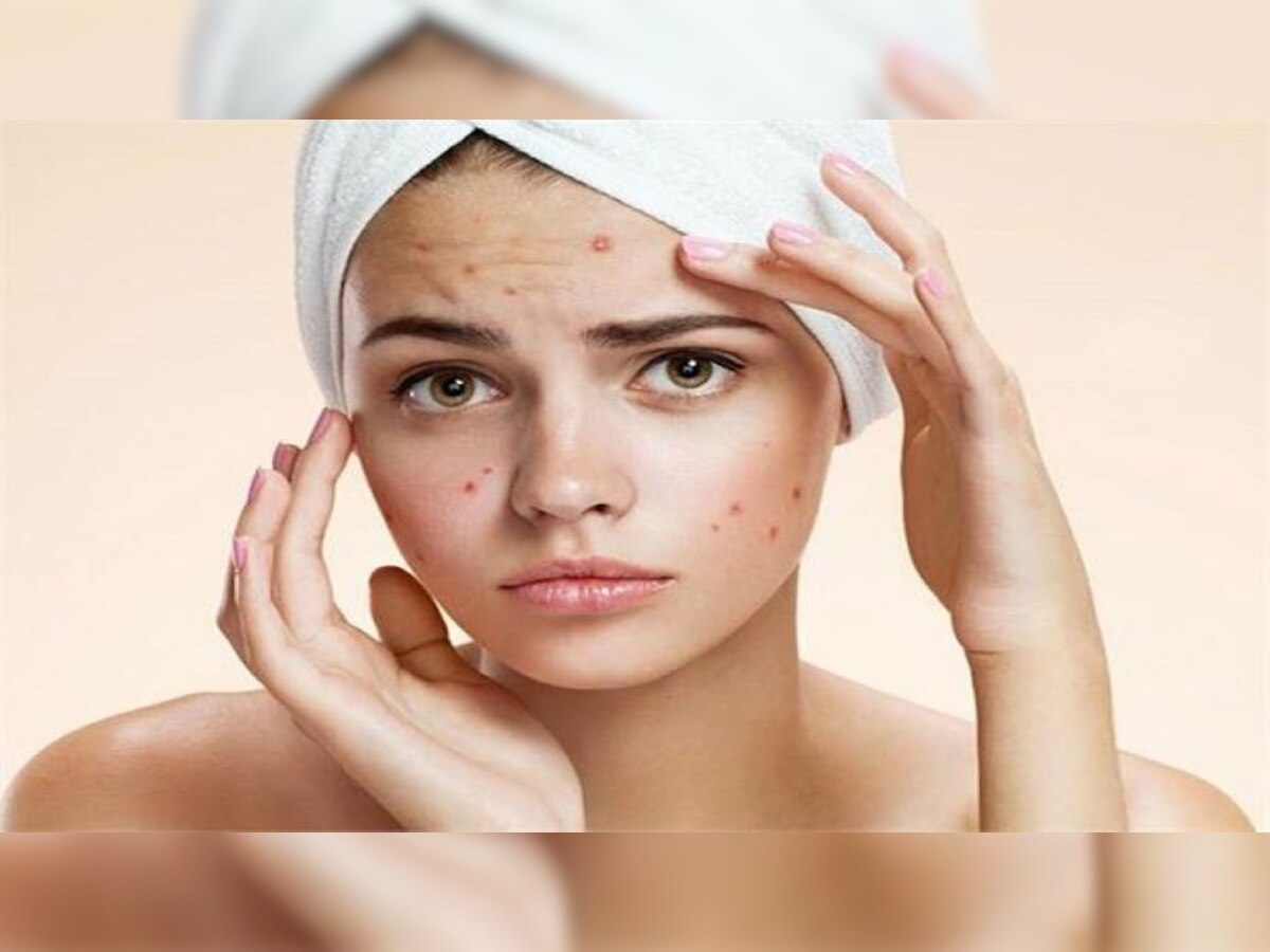 Skin Care Tips: Acne पर भूलकर भी नहीं लगाएं ये चीजें, हो सकती है दिक्कत