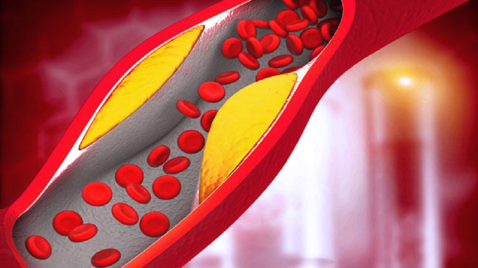 High Cholesterol Foods: इन फूड्स को खाने से फट सकती है नसें, शरीर में बढ़ने लगती है गंदगी High Cholesterol Foods: इन फूड्स को खाने से फट सकती है नसें, शरीर में बढ़ने लगती है गंदगी