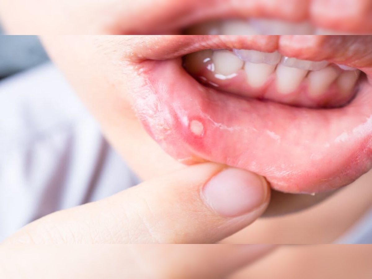 Mouth Ulcer Problem.