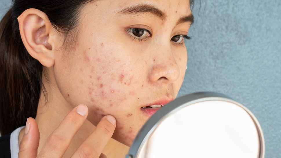 Know Reasons Of Acne Problem And Its Solution | Acne Problem And ...