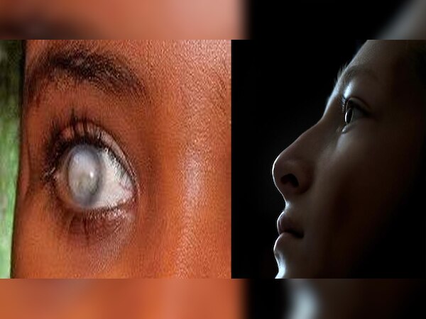 Vitamin A Deficiency: इस कमी से शाम के बाद दिखना हो जाता है बंद, अंधेपन से बचने के लिए खाएं ये चीज